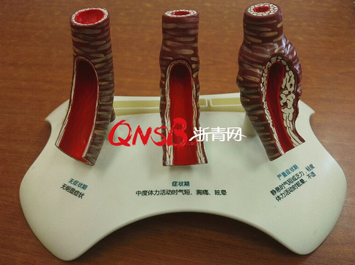 聚餐时喝了半斤白酒,55岁男子突然全身无力,需要移植心脏!